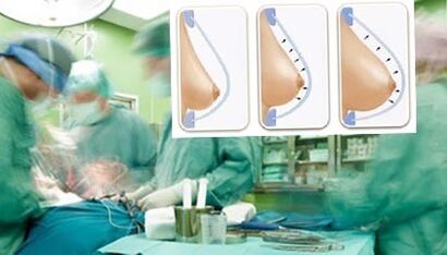 Πώς πραγματοποιείται μια διόρθωση του μαστού