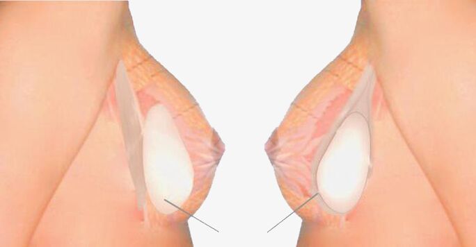 Τι είναι το Mammoplasty