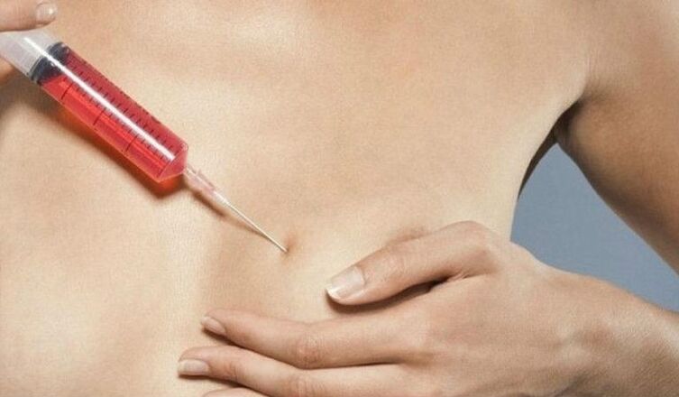 Μεγέθυνση στήθους με ενέσεις υαλουρονικού οξέος