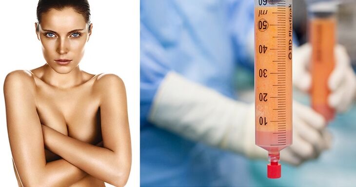 Lipofilling ως μέθοδος μεγέθυνσης στήθους